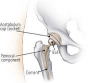 Internal view of the hip from Everyday Health